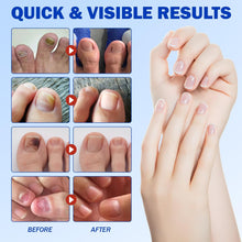 Load image into Gallery viewer, NailHeal - Fungal Nail Patches 🌿💅 ( Buy 1 Get 1 Free🔥🔥)
